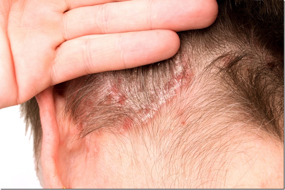 Psoriasis, psoriatic skin disease